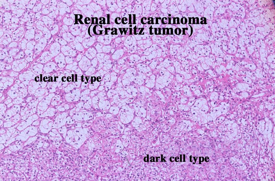 Type Clear renal cell carcinoma 80% Papillary