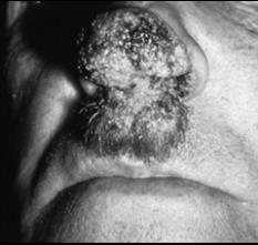 Blastomycosis Inhalatie van sporen Vorming van