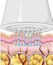 Meta Therapy VERSUS ANDERE DIEPGAANDE BEHANDELINGEN Meta Therapy Ultra dunne naaldjes maken pijnloos onzichtbare microperforaties in de huid.