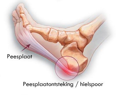 FASCIITIS PLANTARIS Ontsteking van de fascie aan