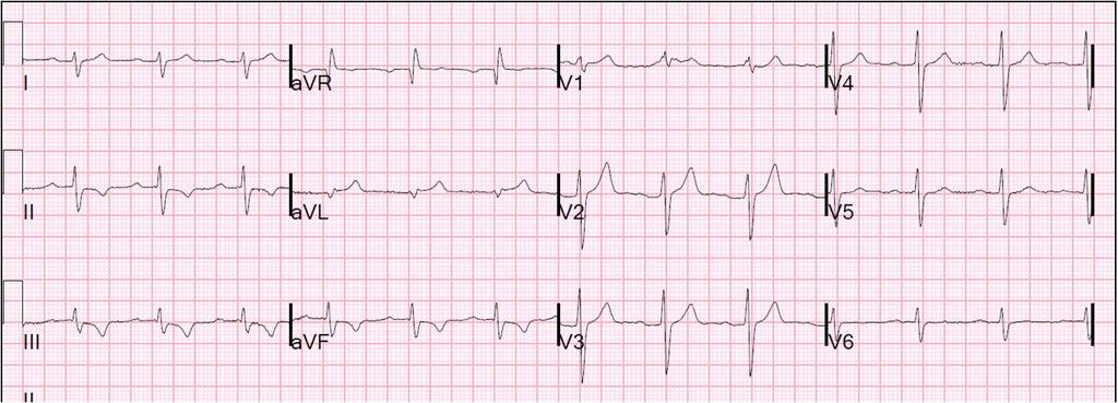 17 NSTEMI