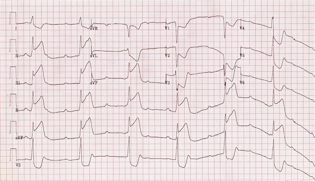 19 STEMI