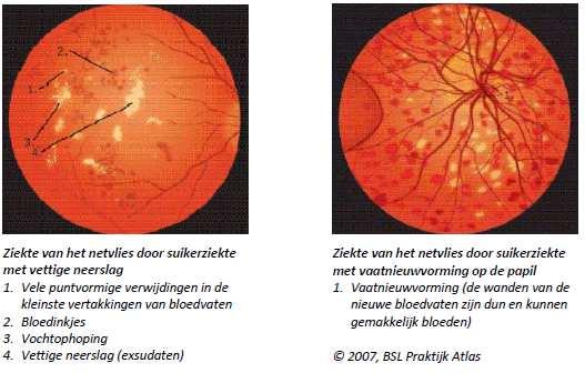 3 Diagnose Bij het onderzoek door de oogarts worden de pupillen met druppels verwijd, zodat het netvlies goed kan worden bekeken.