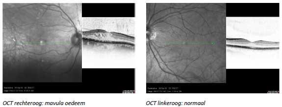 4 Behandeling 4 Het doel van de behandeling is de retinopathie af te remmen en zo slechtziendheid te voorkomen of te beperken.