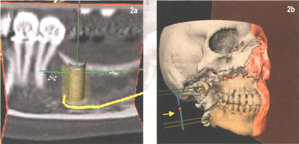 Voorbeeld van coronaal en axiaal CT beeld, samen met het gesimuleerde implantaatmodel.