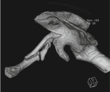 Figuur 3. Pseudarthrose van de clavicula. wordt een slechtere schouderfunctie beschreven na conservatieve behandeling ten gevolge van de verkorting van 1 tot 2 cm.