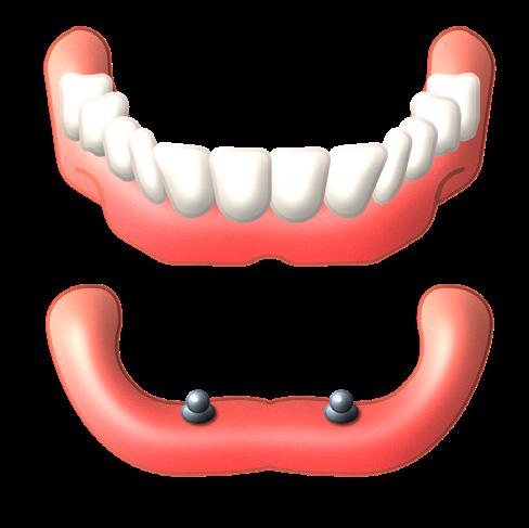 Wat is een implantaat? Een implantaat kunt u vergelijken met een kunstwortel, die als een schroef in de kaak wordt geplaatst. Deze komt op de plaats waar vroeger uw tanden en kiezen stonden.