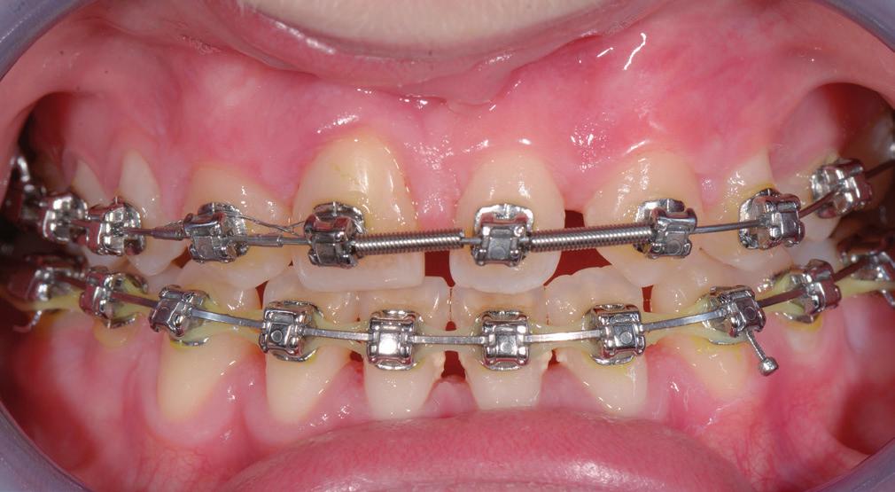 Orthodontie Er is een gering ruimtegebrek in beide tandbogen, inversie van de fronten, een diepe beet en een neutro-occlusie op de molaren (afbeelding 21).