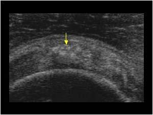 Tendinitis calcarea