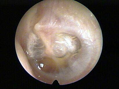 Casus 6: oorpijn totaal 4 punten -vraag 19 t/m 21- Een jongen van 6 jaar komt in mei bij de huisarts omdat hij druk voelt op zijn linker oor sinds een paar maanden.