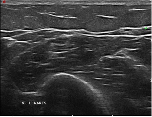 Figuur 14: n.ulnaris thv de bovenarm Elleboog regio Vervolg de n. ulnaris vanuit proximaal richting de mediale epicondyl, het benige uitsteeksel van de humerus aan deze zijde.