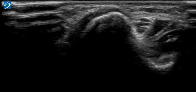 Figuur 17: n. ulnaris thv sulcus Onderarm Vervolg de n. ulnaris vanuit de elleboog richting onderarm. Distaal van de cubitale tunnel is de n. ulnaris herkenbaar onder de m.
