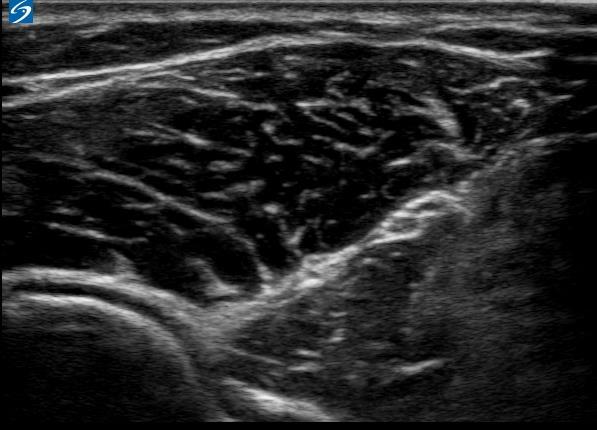 Figuur 24 diepe en oppervlakkige tak; n radialis profundus en n.radialis superficialis. De n.