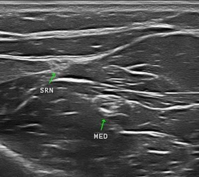 brachioradialis ligt. Net proximaal van de pols gaan zenuw en arterie uit elkaar en kruist de n. radialis superficialis de pees van de m.