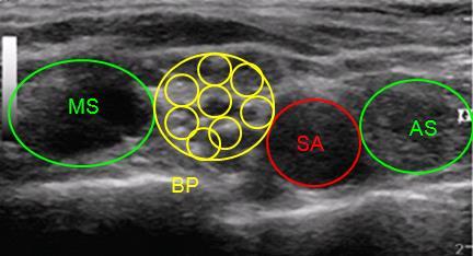 Supraclaviculaire plexus Net boven de clavicula is de plexus brachialis te zien naast de arteria subclavia als een soort druiventros ( cluster of grapes ), waarbij de verschillende fasciculi in een