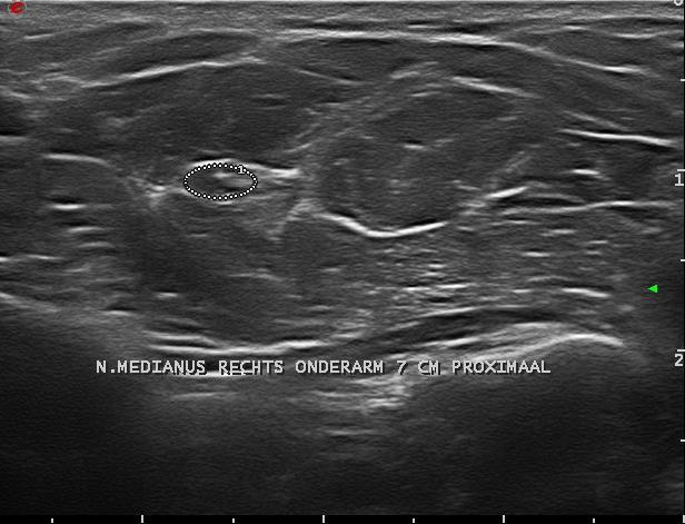 Figuur 6: n. medianus thv de onderarm Proximale onderarm en elleboog Probe richting mediale epicondyle bewegen. De n. medianus maakt op ongeveer 2/3 van de onderarm een bocht onder de m.