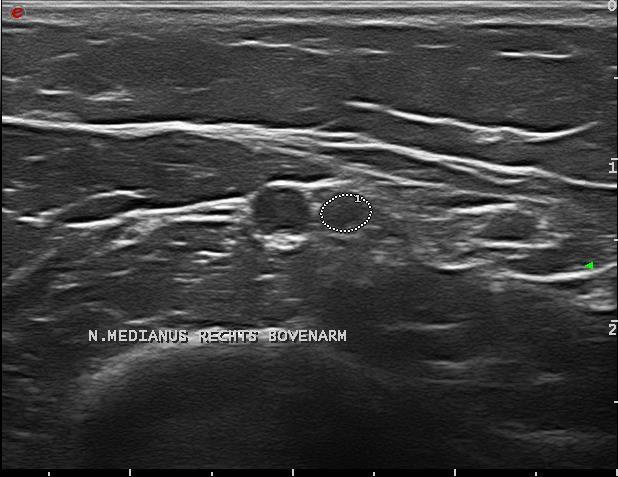 1/3 Bovenarm Probe vanaf elleboogplooi naar mediaal en proximaal bewegen, de humerus komt in beeld en de n. medianus ligt nog steeds naast de a. brachialis (figuur 10) Figuur 10: n.