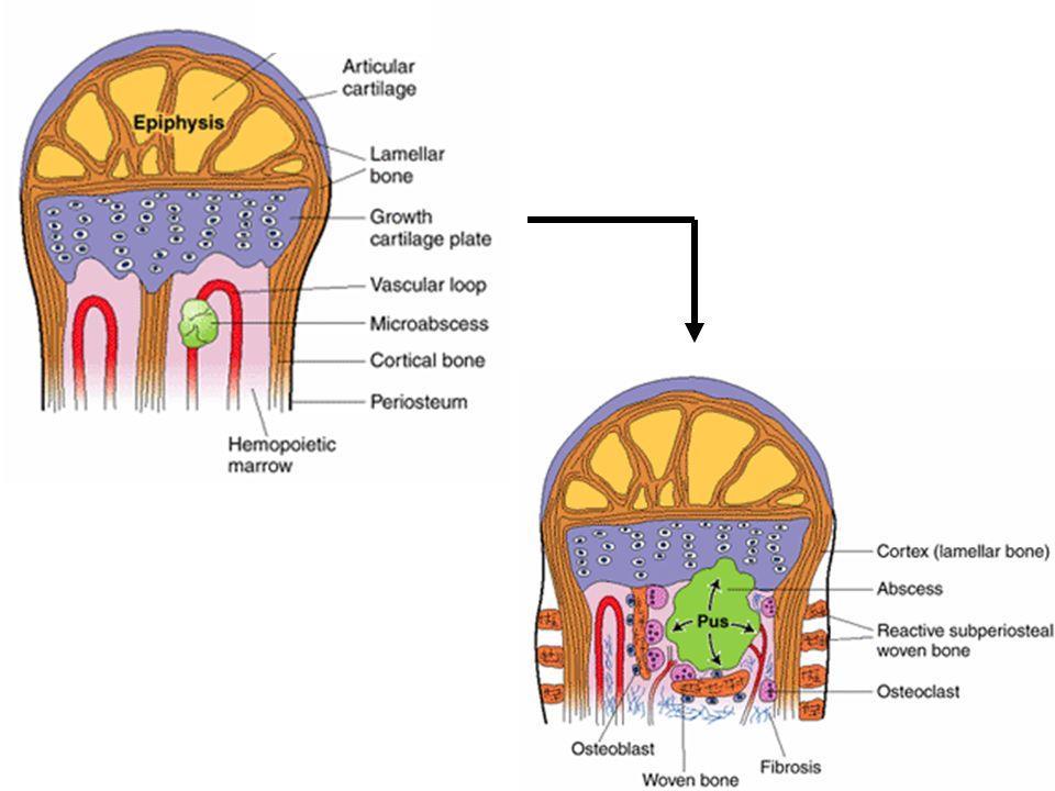 Osteoarticulaire infecties Acute hematogene osteomyelitis Chronisch