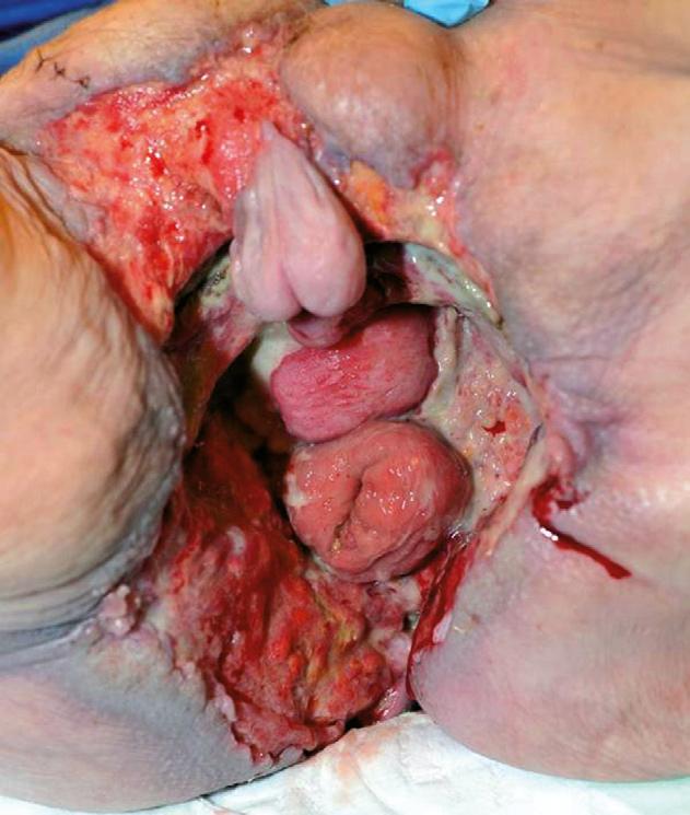 urethra labium majus pudendi vaginavoorwand rectum FIGUUR 1 Foto van de anogenitale regio van patiënt A, die het destructieve natuurlijke beloop toont van een