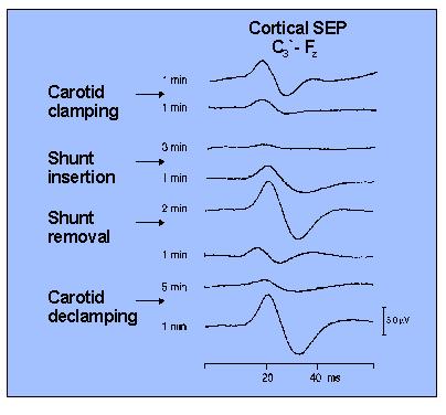 EEG - SSEP Functionaliteit van neuronen functie stopt indien CBF < 16-18 ml/100g/min celdood indien CBF < 10-12 ml/100g/min EEG :