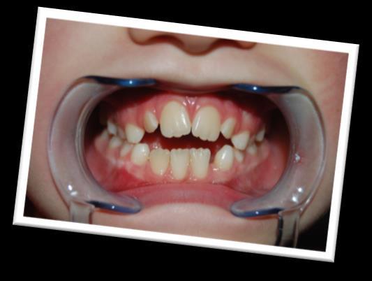 Doordat de tong tijdens dit afwijkend slikken telkens tegen de tanden duwt, kunnen de tanden scheef gaan staan.
