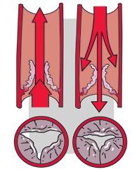 Door de zwaartekracht stroomt het bloed terug, de verkeerde richting op naar het onderbeen en kunnen zich spataderen ontwikkelen.