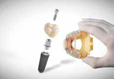 abutment 698 8 565 All-in implant All-on-5 onder- of bovenkaak inclusief Avinent implantaten en healing abutments 5761 Implantaat met Zirkon kroon incl.