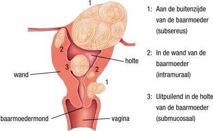 Wat zijn myomen? Myomen (vleesbomen) zijn goedaardige knobbels in de spierlaag van de baarmoeder en bestaan vooral uit spierweefsel.