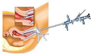 Figuur 1: De hysteroscoop wordt via de schede in de baarmoederholte gebracht. 1. baarmoederwand 2. baarmoederholte 3.