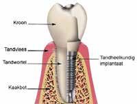 5 Een nieuw gebit: tandprothesen Als je 1 of meerdere natuurlijke tanden verliest, zorgt een tandprothese voor een stralend nieuw gebit.