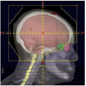 Hersenmetastasen radiotherapie (1) Schedelinhoud (WBRT): Bij RPA I of