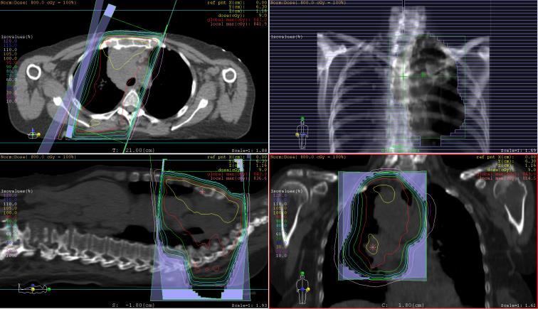 VCSS behandeling Corticosteroïden Bij acute dyspnoe of hersenoedeem Dexamethason, 1dd 8-16 mg Chemotherapie Eerste keus bij bronchuscarcinoom of lymfoom (snelle respons) Effect binnen dagen