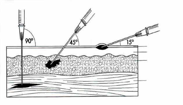 De naald wordt bijna evenwijdig aan het huidoppervlak ingebracht met een maximale hoek van 15 graden tussen de naald en de huid (schuine kant van de punt naar boven).