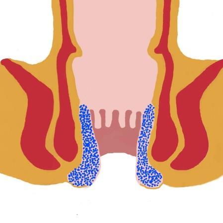 Ligasure hemorroïdectomie voor aambeien. Aambeien zij opgezwollen en uitgezakte zwellichaampjes thv de aars.