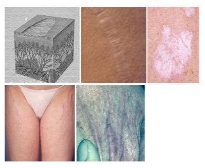 Alle delen van de huid kunnen atrofie vertonen Verdunning van de epidermis: een dunne, gerimpelde,