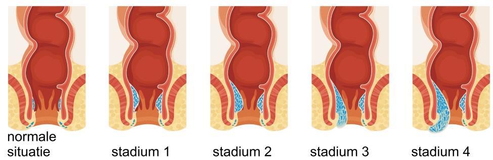 Aambeien kunnen steeds groter worden en opzwellen. Uiteindelijk kunnen ze buiten uw anus uitpuilen. Dit kan jeuk of een vervelend gevoel rond de anus veroorzaken.