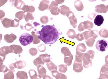 t(1;22)(p13;q13); RBM15-MKL1 megakaryoblastaire leukemie = zeer zeldzaam!