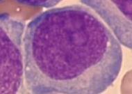 vormen Promyelocyten Hypergranulaire vorm: abnormale promyelocyten