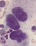 Monoblasten/promonocyten Geen specifieke blastenmorfologie Basofilie
