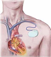 6 U wordt opgenomen voor de implantatie van een pacemaker of defibrillator 7 3. De defibrillator 4. De implantatie 3.1 Wanneer?