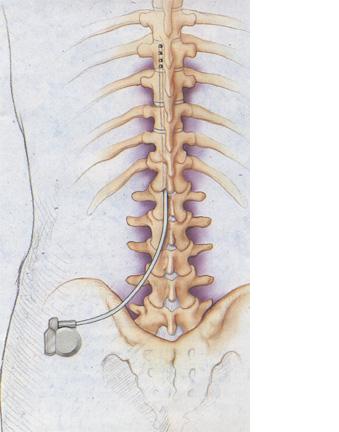 De definitieve implantatie U komt in aanmerking voor een definitieve neurostimulator wanneer u nadat de termijn voor de proefbehandeling verstreken is een goede pijnvermindering heeft en/of