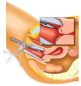 Figuur 7. Conisatie: de arts snijdt een kegelvormig stukje uit de baarmoedermond Na de conisatie plaatst de gynaecoloog soms een tampon in de schede vanwege het bloedverlies.