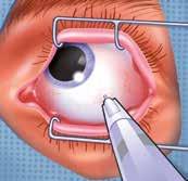 Uw oog zal opengehouden worden met behulp van een ooglidspeculum. Uw arts zal de injectie plaatsen in het witte deel van uw oogbol.