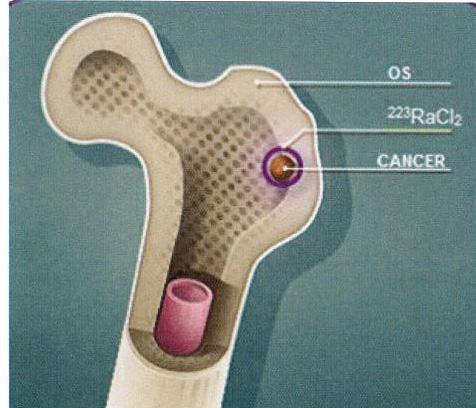 1 Werking Xofigo wordt gebruikt voor de behandeling van volwassenen met uitgezaaide castratieresistente prostaatkanker.