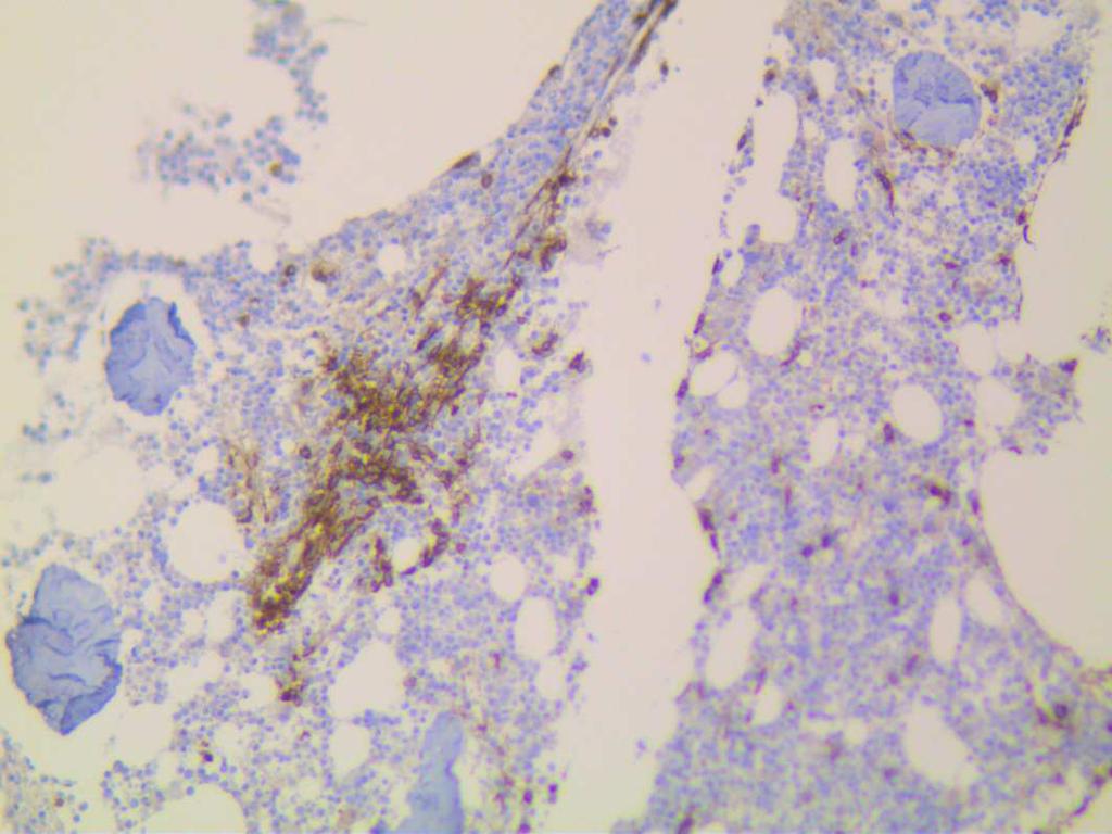 BM biopt (pathologie) Beenmergbiopt met haarden van