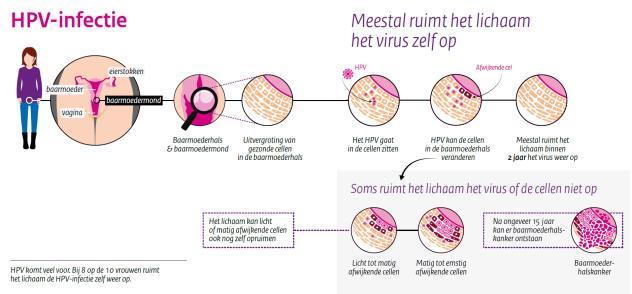 hrhpv en baarmoederhalskanker (I) hrhpv en baarmoederhalskanker (II) Woodman, 2007, Nature Reviews