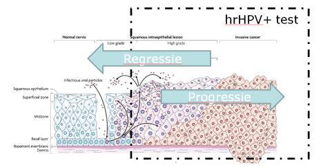 cellen/voorstadia opruimen (regressie) hrhpvinfectie en hrhpv test Actief hrhpv Grenswaarde hrhpv-test -