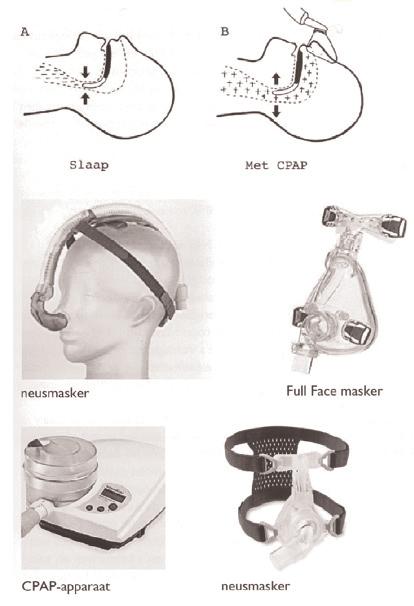 Het CPAP-apparaat ondersteunt uw ademhaling continu, zowel tijdens het in- als tijdens het uitademen. Hierdoor blijft de luchtweg open en treden er minder ademstilstanden op.