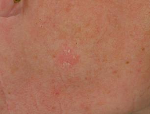 Keratosis