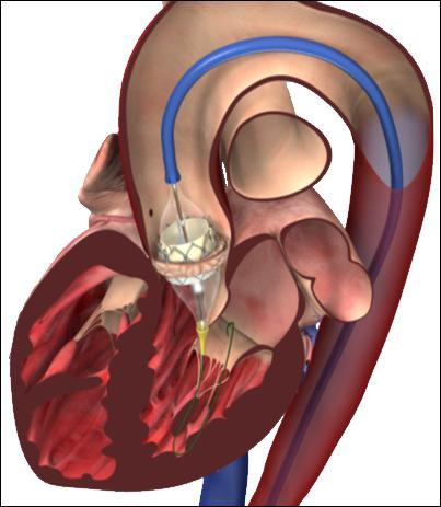 7. Implantatie via de lies (transfemoraal, TF-AVI) Een transkatheter aortaklepimplantatie via de liesslagader (arteria femoralis, transfemorale ingreep) vindt plaats op de hartkatheterisatiekamer.